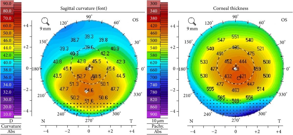 Example corneal topography and thickness maps in keratoconus